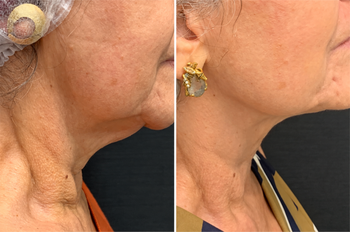 Clinical Jawline Before-and-After Comparison