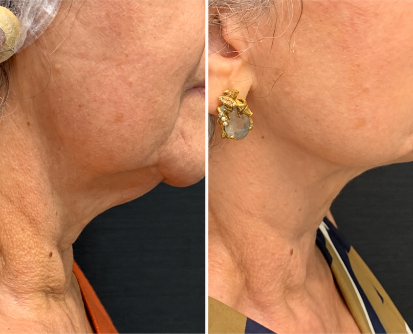 Clinical Jawline Before-and-After Comparison