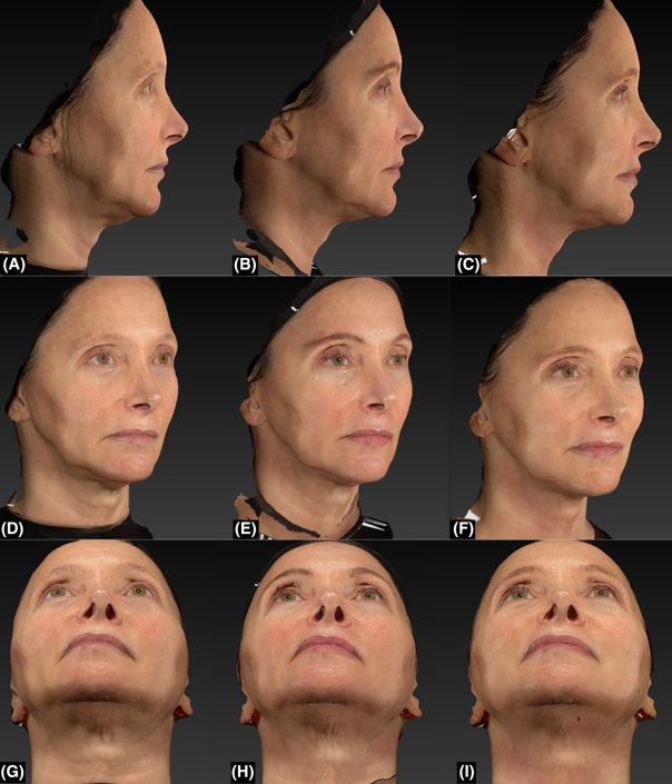 golden-neck-real-results